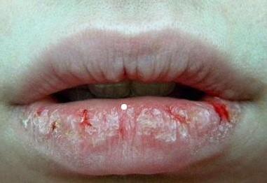 唇炎會(huì)自己恢復(fù)嗎？