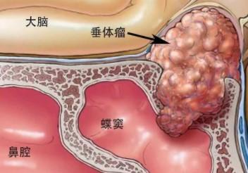 高催乳素血癥的癥狀有哪些？