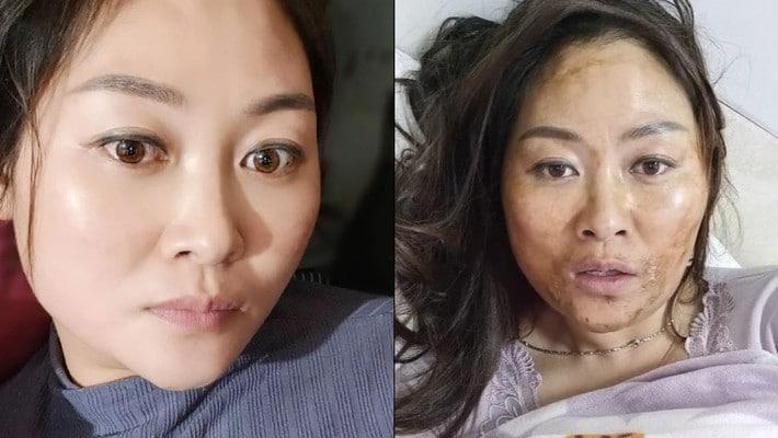 女子感染新冠高燒后滿臉發黑