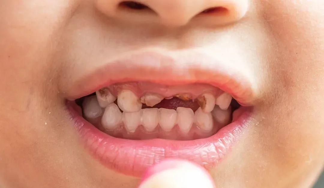 寶寶兩歲半門牙腐蝕怎么治療?