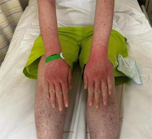 杭州女子吳霞中恙蟲病，全身紅斑如火龍果，20元倉鼠引發傳染風險！