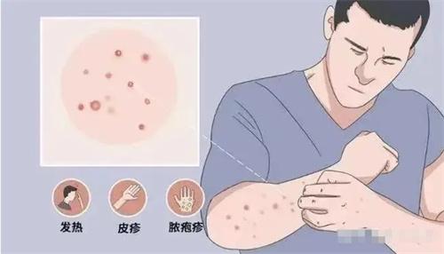 天津、長沙等地發現猴痘病例，猴痘病毒感染引發關注