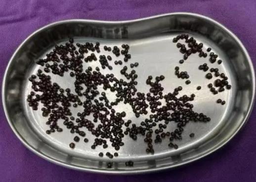 誤診為胃病！66歲王阿姨腹痛腹脹半年，最終發(fā)現(xiàn)膽囊結(jié)石